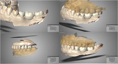 3D-printed resin composite posterior fixed dental prosthesis: a prospective clinical trial up to 1 year